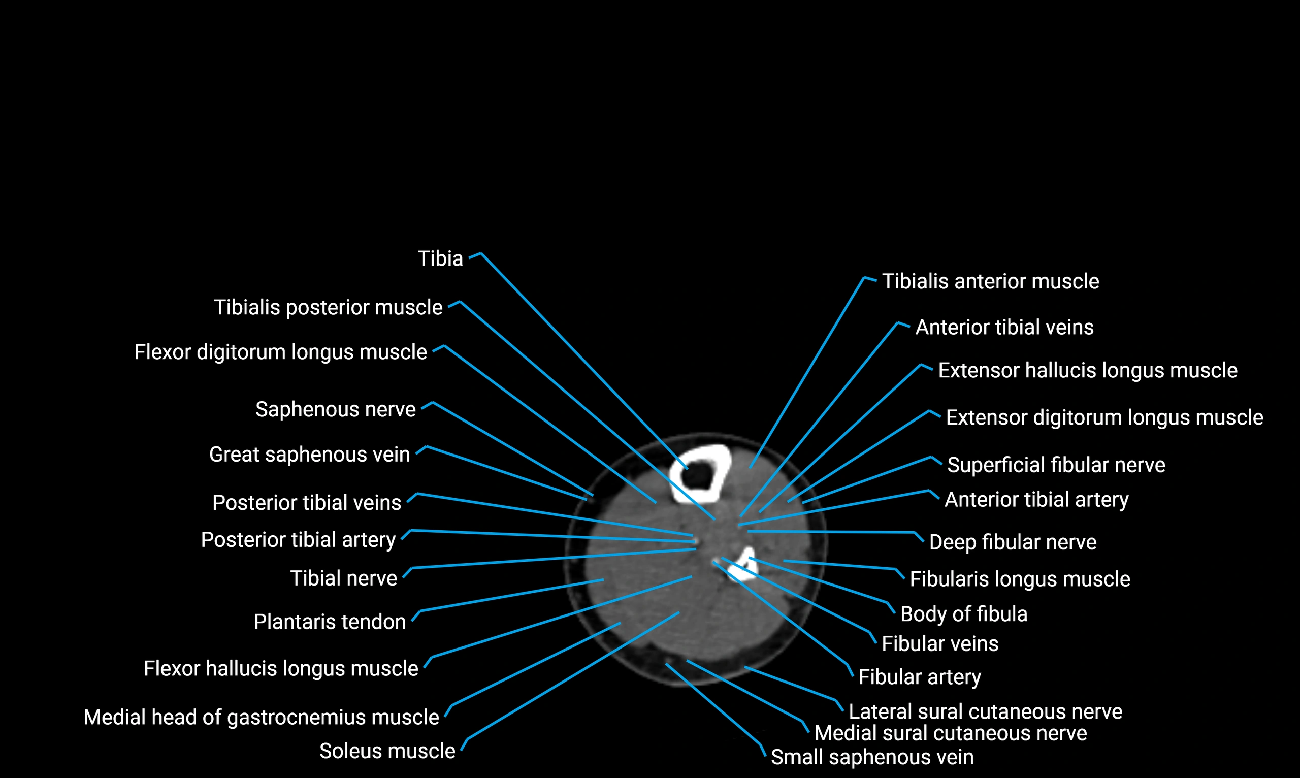 CT lower limb axial cross sectional anatomy labelled image 119 (2).webp